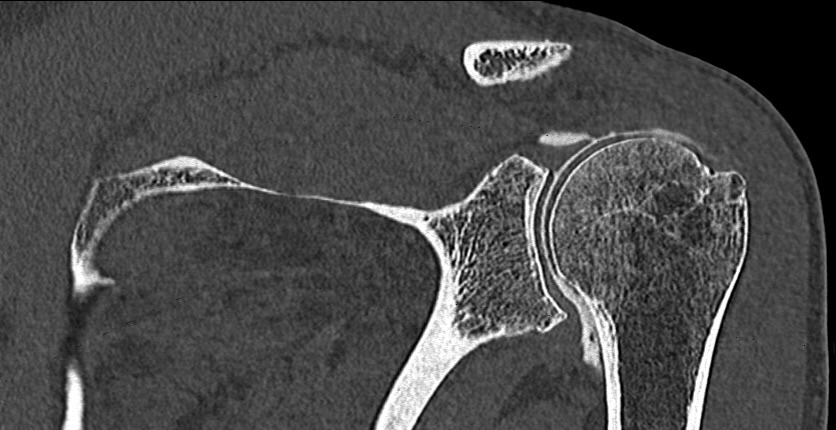 Arthroscanner – injection intra-articulaire – IMCSM