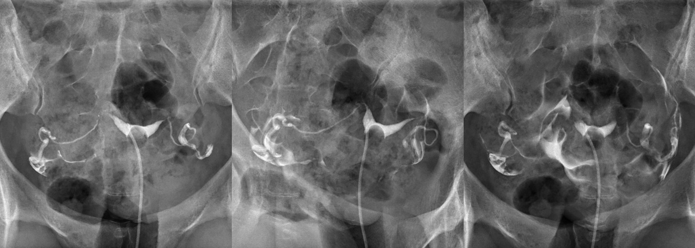 Clichés d'hystérosalpingographie : opacification de la cavité utérine et des trompes de Fallope