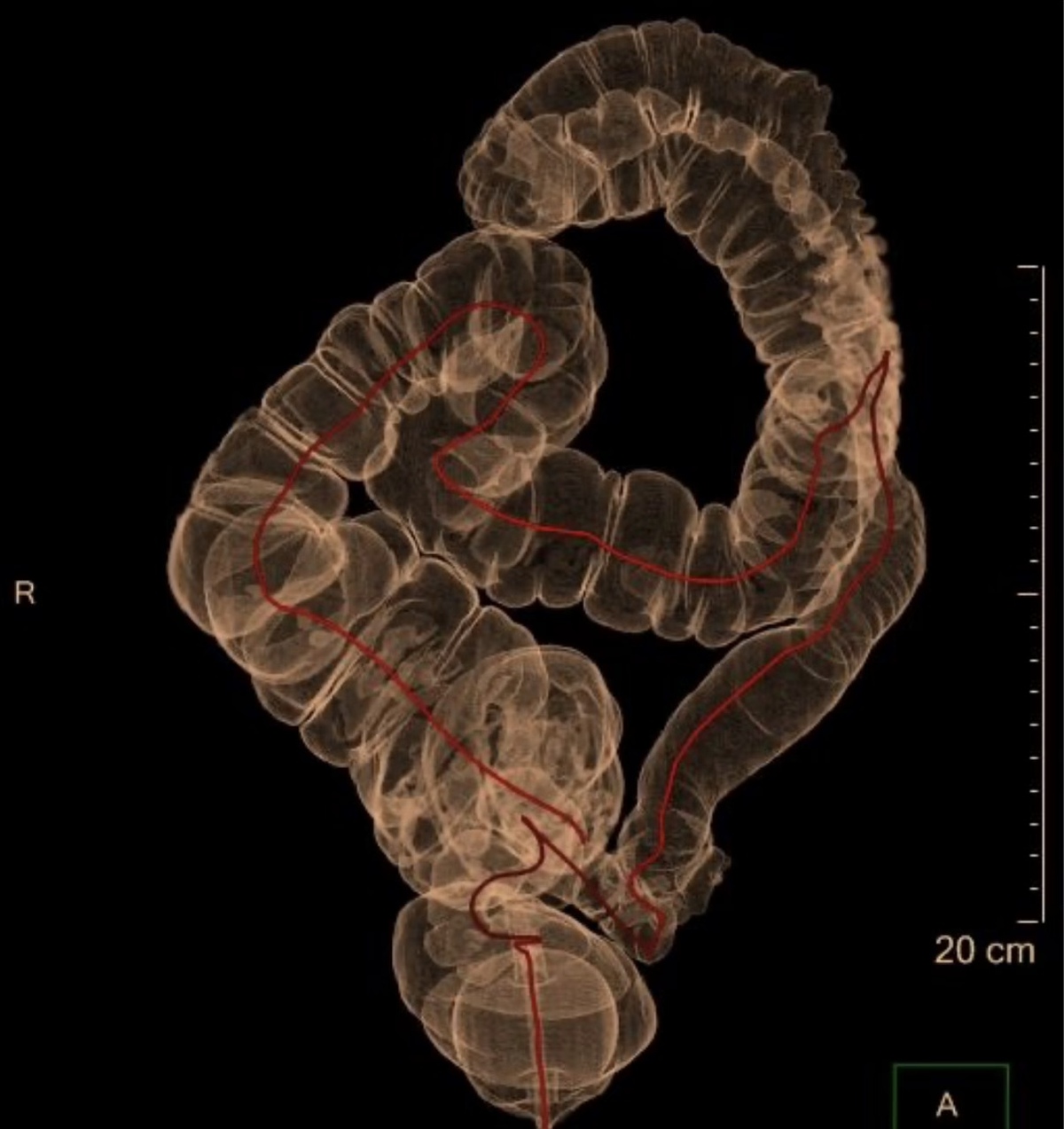 Coloscanner – reconstruction 3D du côlon – IMCSM