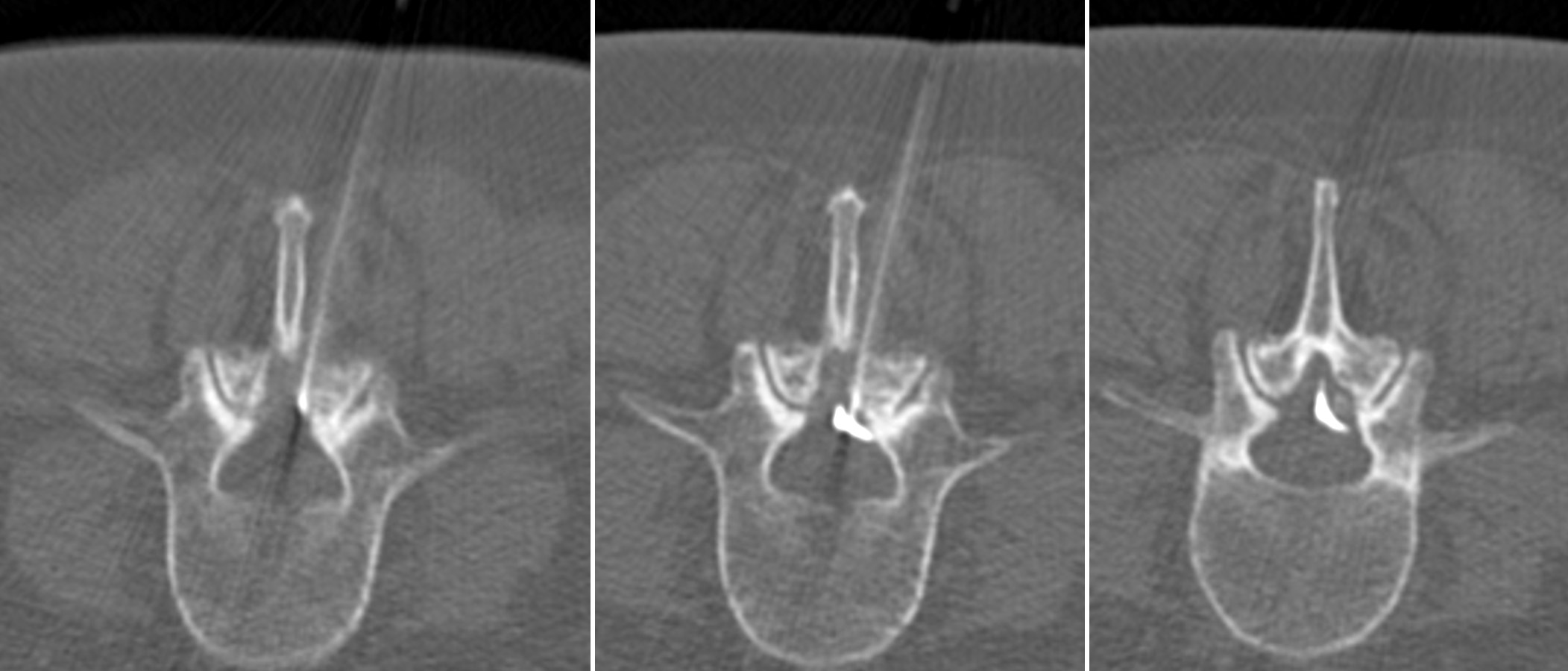 Infiltration épidurale lombaire sous scanner – IMCSM