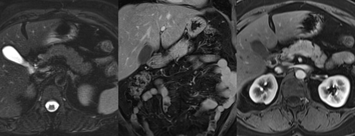 IRM abdominale – coupes d'imagerie de l'abdomen – IMCSM