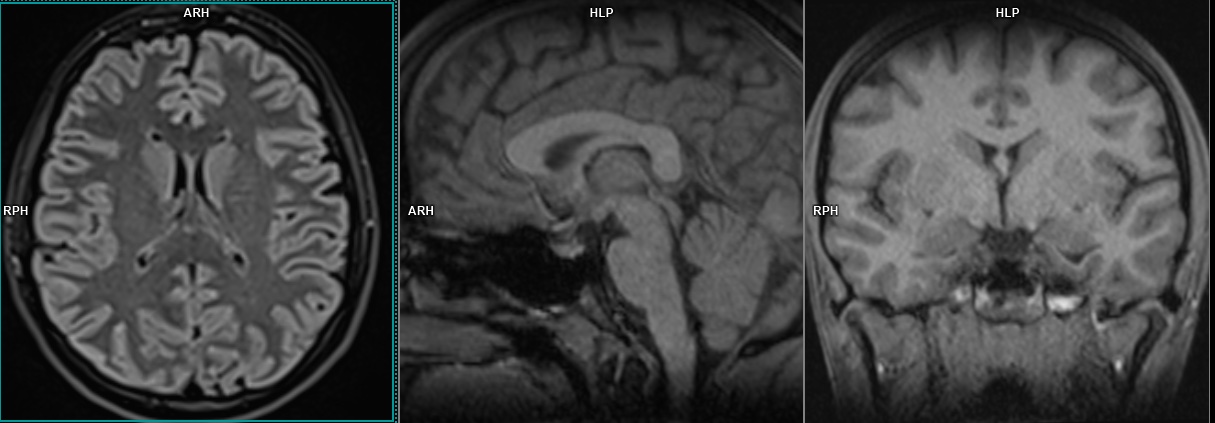 IRM cérébrale – coupes du cerveau – IMCSM