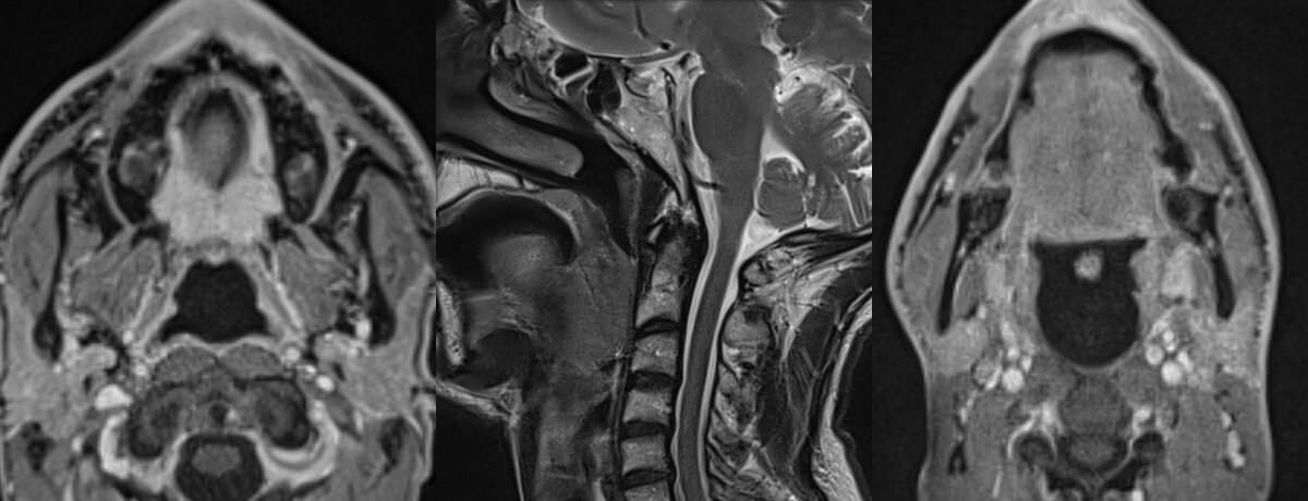 IRM ORL (cervico-faciale) – IMCSM