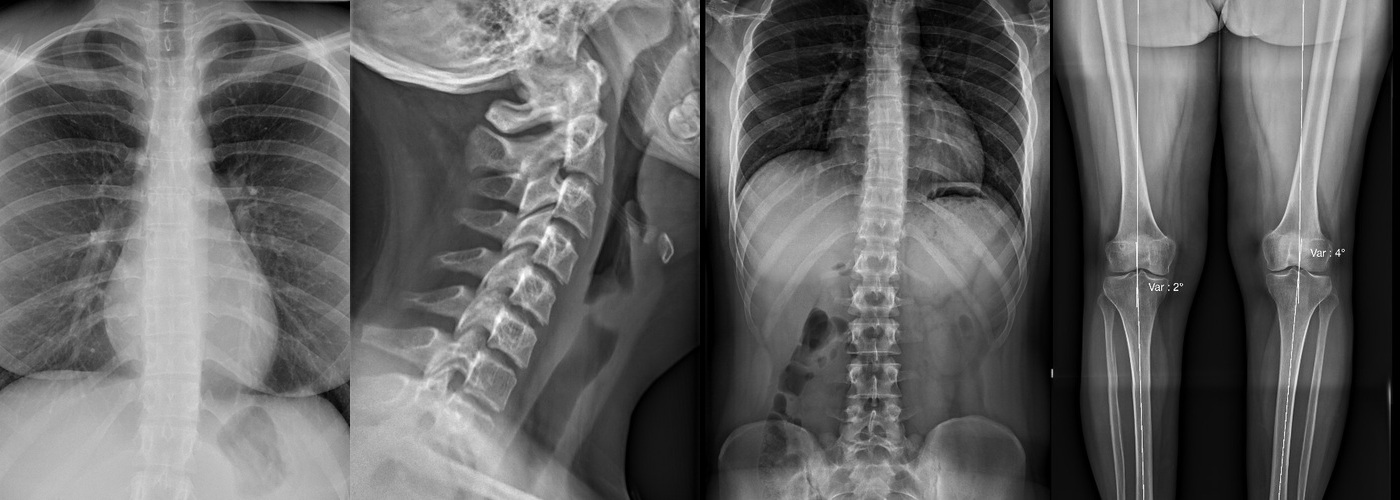 Salle de radiographie de l'IMCSM – table télécommandée Stephanix